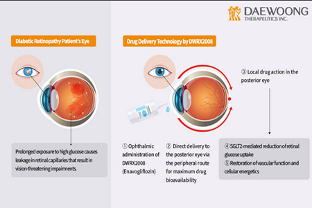 World's First Eyedrop Treatment for Diabetic Retinopathy and Macular Edema
