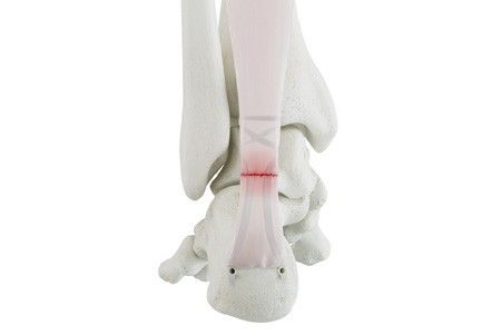 Medline UNITE is set to launch Achilles repair systems